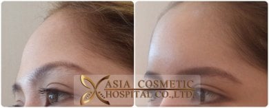 before-after photo plastika-lba-implant