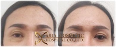 before-after photo plastika-lba-implant