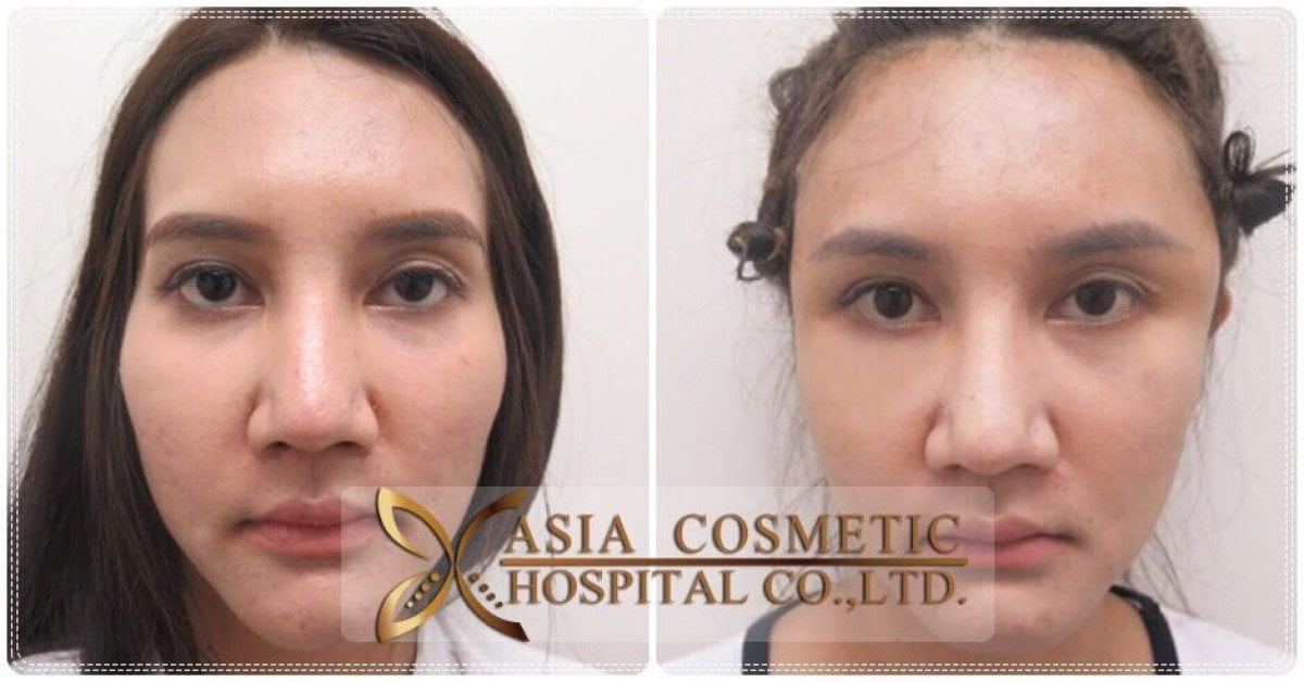 Resultados antes y después de aumento de frente con implante en Asia Cosmetic Hospital, contorno mejorado