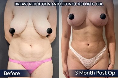before-after photo 360-liposuction