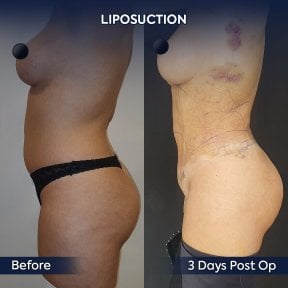 before-after photo 360-liposuction