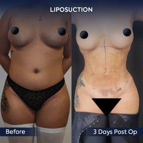 before-after photo 360-liposuction