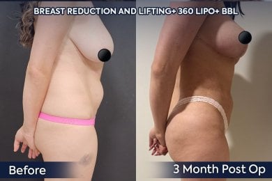 before-after photo 360-liposuction