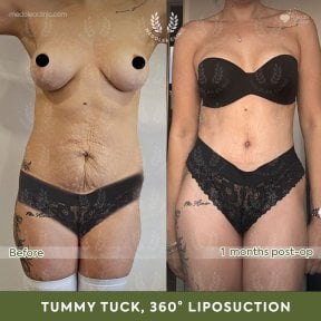 before-after photo 360-liposuction