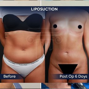 before-after photo 360-liposuction