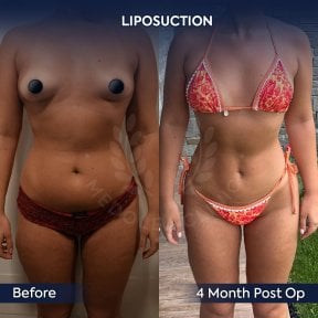 before-after photo 360-liposuction
