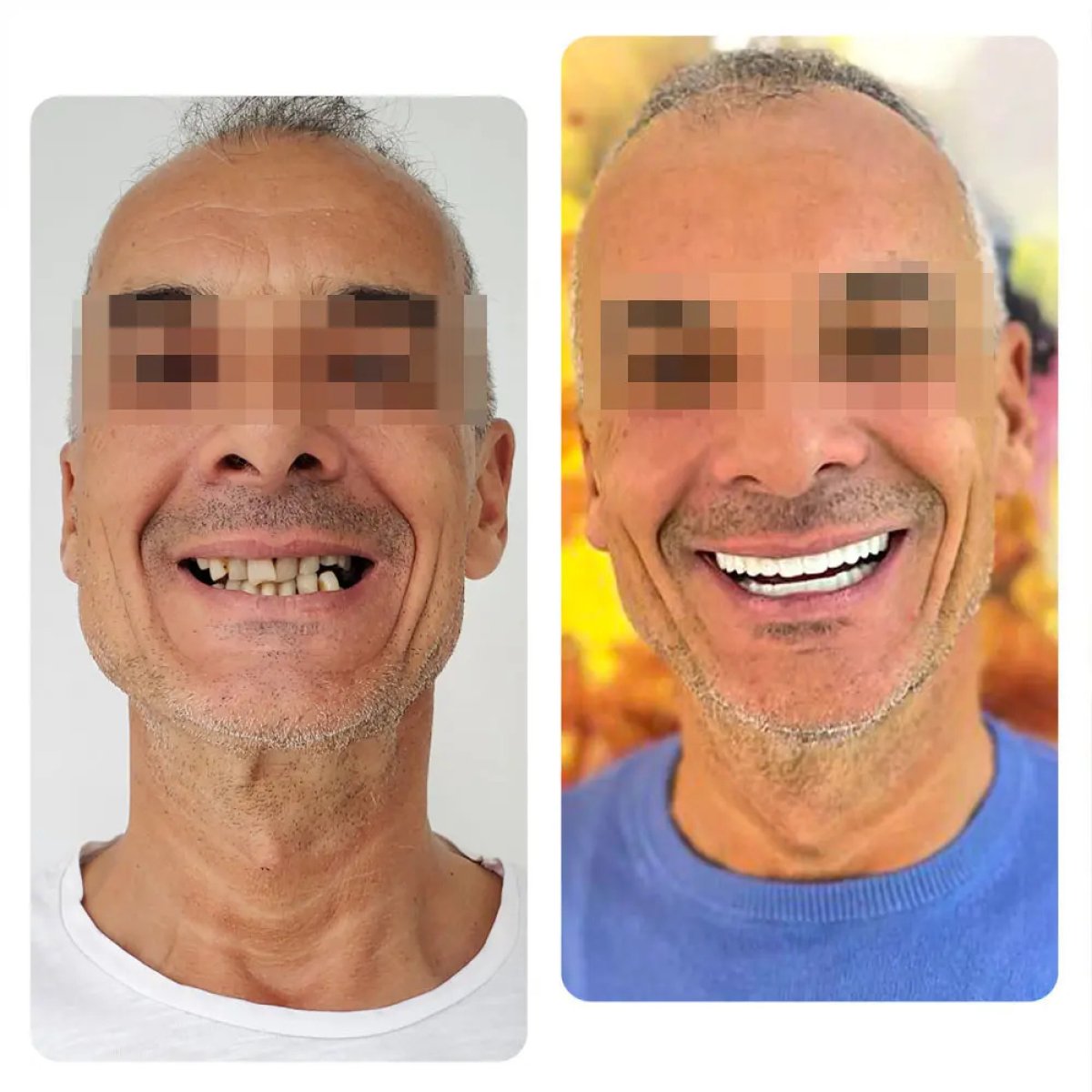 نتائج قبل وبعد زراعة الأسنان – ابتسامة مستعادة وتحول كامل للأسنان