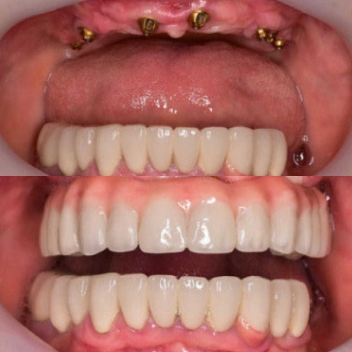 نتائج قبل وبعد زراعة الأسنان All-on-6 في Facialia Clínica، ابتسامة مستعادة