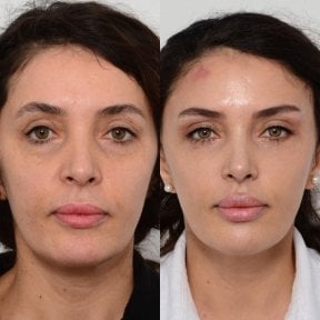 before-after photo blepharoplasty-eyelid