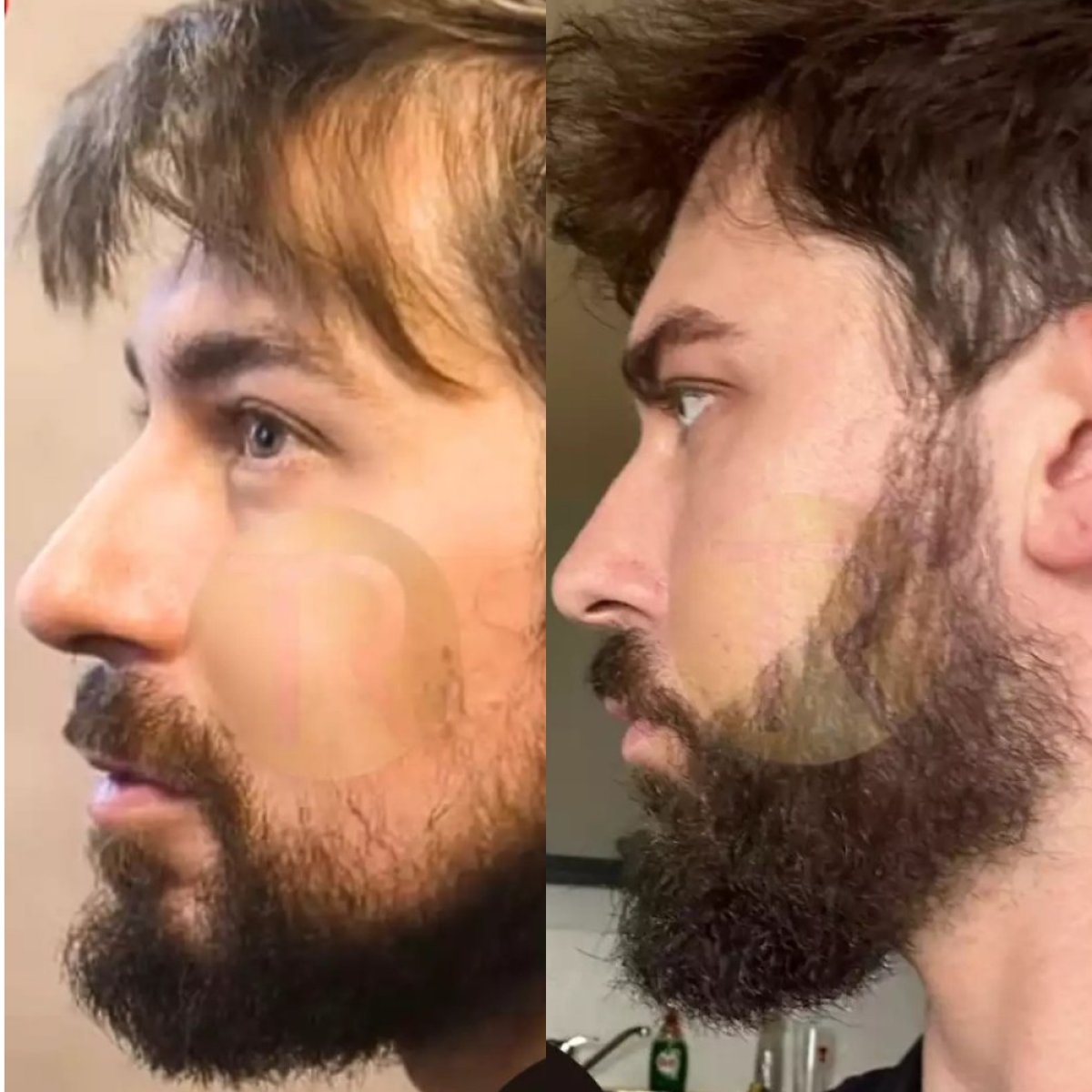 نتائج قبل وبعد زراعة الشارب في مركز Transes Hair Transplant، كثافة شعر الوجه