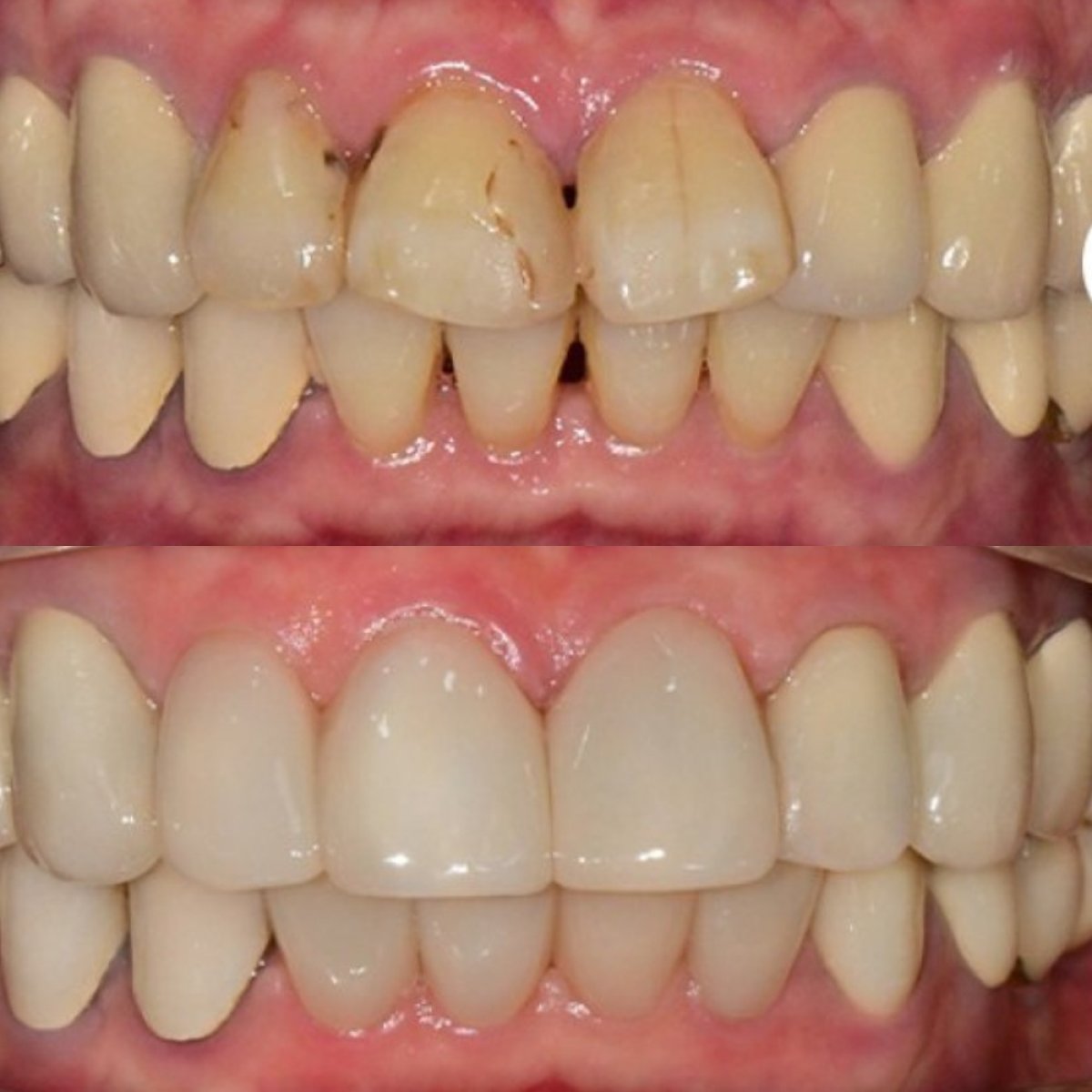 نتيجة قبل وبعد قشور الأسنان بدون تحضير في عيادة Yonsei Dagam Dental Office