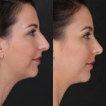 نتائج عملية تجميل الأنف قبل وبعد في Holiday Estetic، تحسين شكل الأنف والملف الجانبي