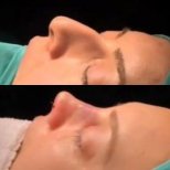 نتائج تجميل الأنف قبل وبعد في Sona Health Clinic، تحسين شكل الأنف والملف الجانبي