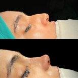نتائج تجميل الأنف قبل وبعد في Sona Health Clinic، تحسين شكل الأنف والملف الجانبي