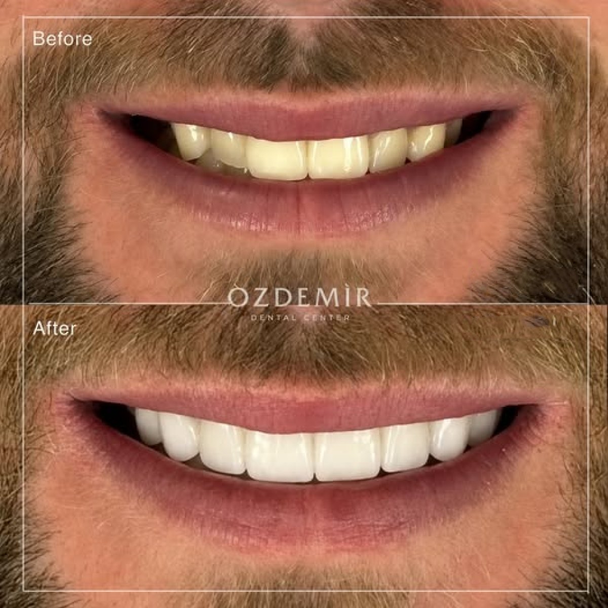نتائج تبييض الأسنان قبل وبعد في Özdemir Dental Center، ابتسامة أكثر بياضاً