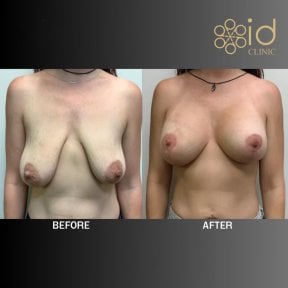 before-after photo umensenie-grudi