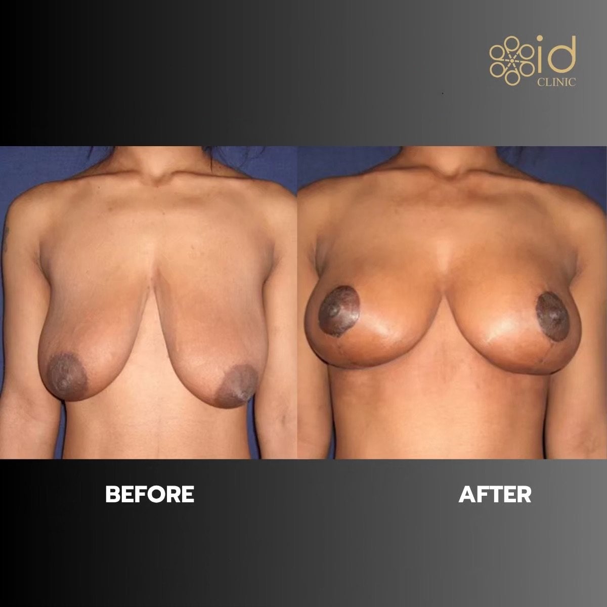 نتائج تصغير الثدي قبل وبعد في ID Clinic Bangkok، تحسين شكل ورفع الثدي