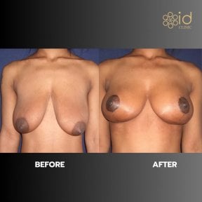 before-after photo umensenie-grudi