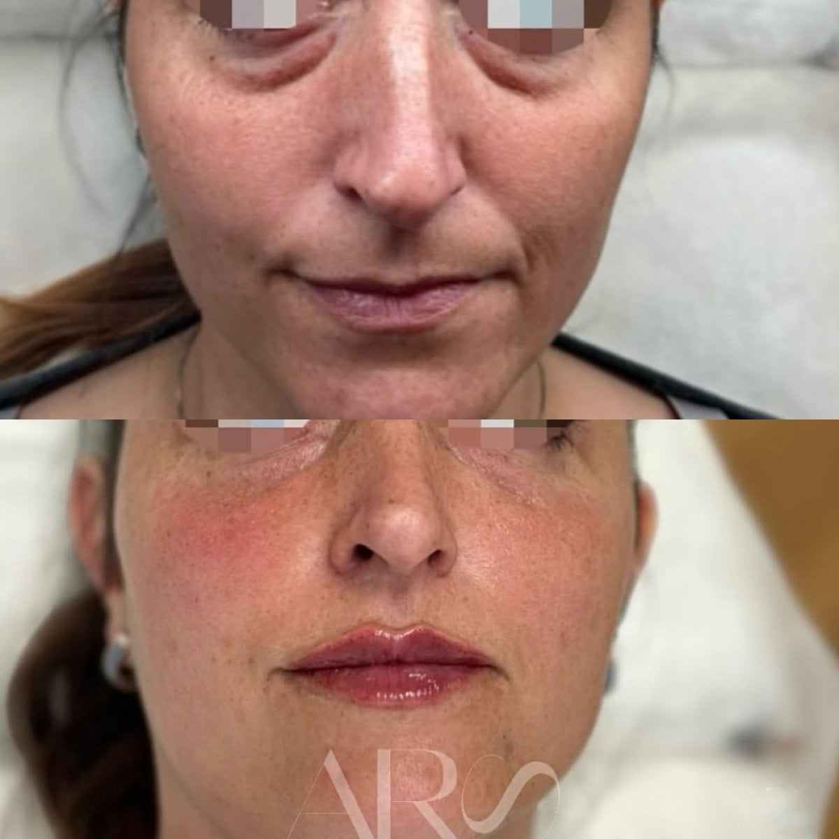 Antes y después de rellenos en ARS Clinic, rejuvenecimiento facial y labios mejorados