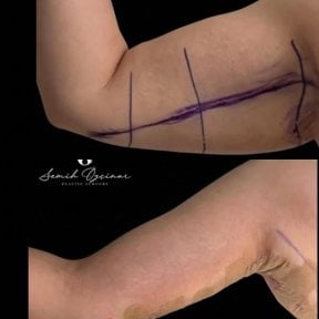 before-after photo arms-plastics-brachioplasty
