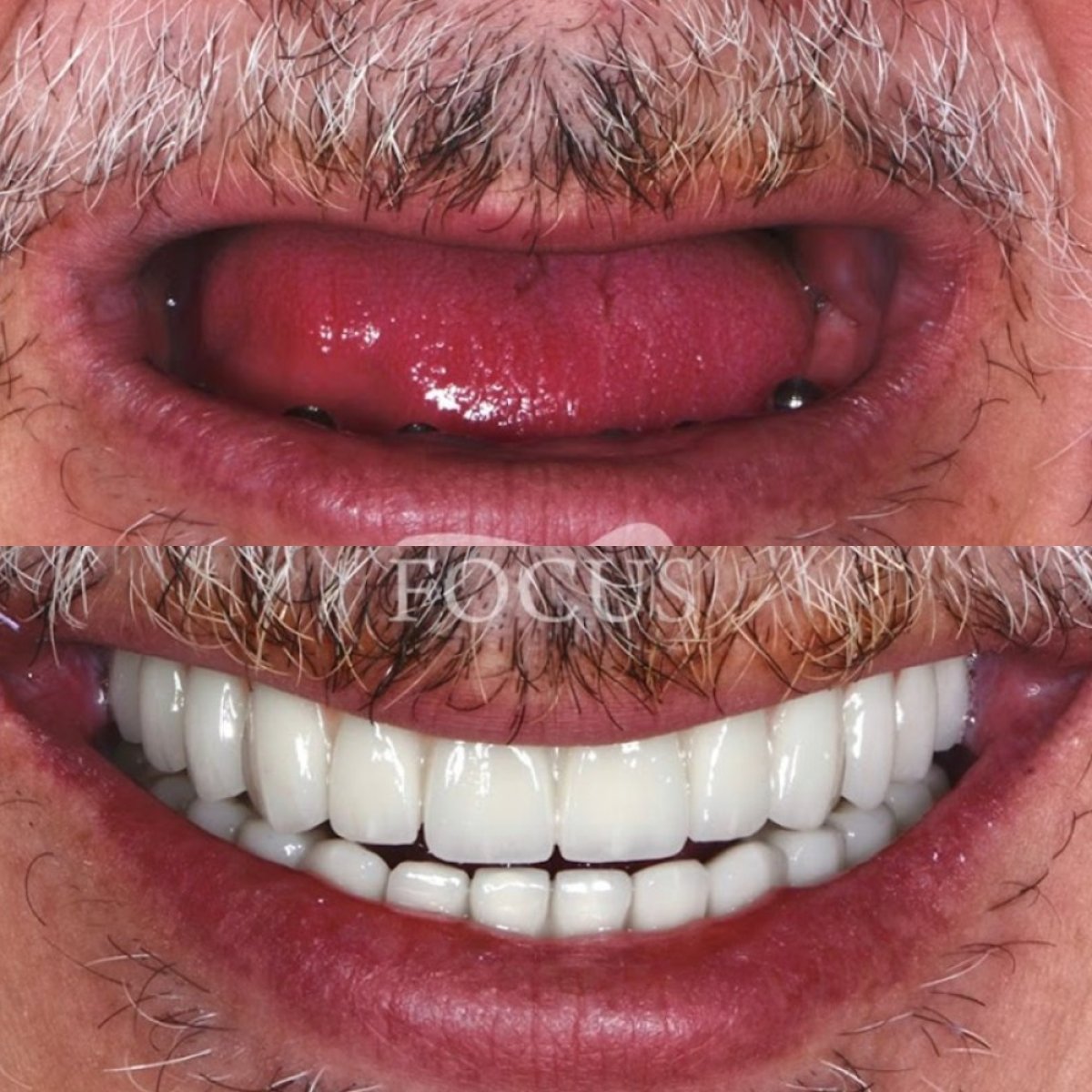 Resultado antes y después de implantes All-on-4 en Focus Dental Clinic - Bodrum, restauración de sonrisa