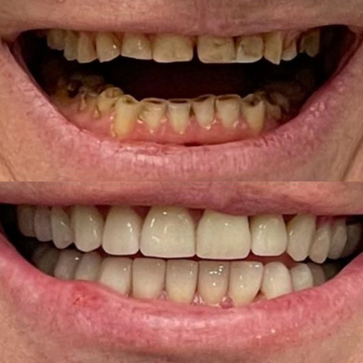 Resultados antes y después de coronas dentales en Completdent Clinic, mejora estética de la sonrisa