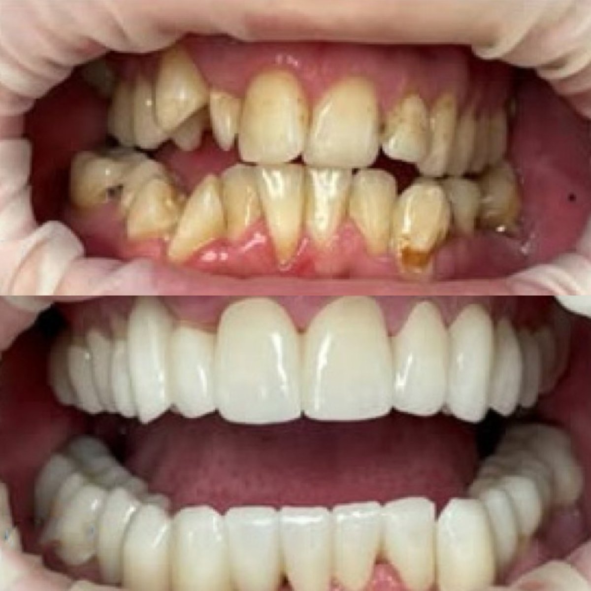 نتائج قبل وبعد تركيب تيجان الزركونيا في عيادة Completdent، استعادة الابتسامة