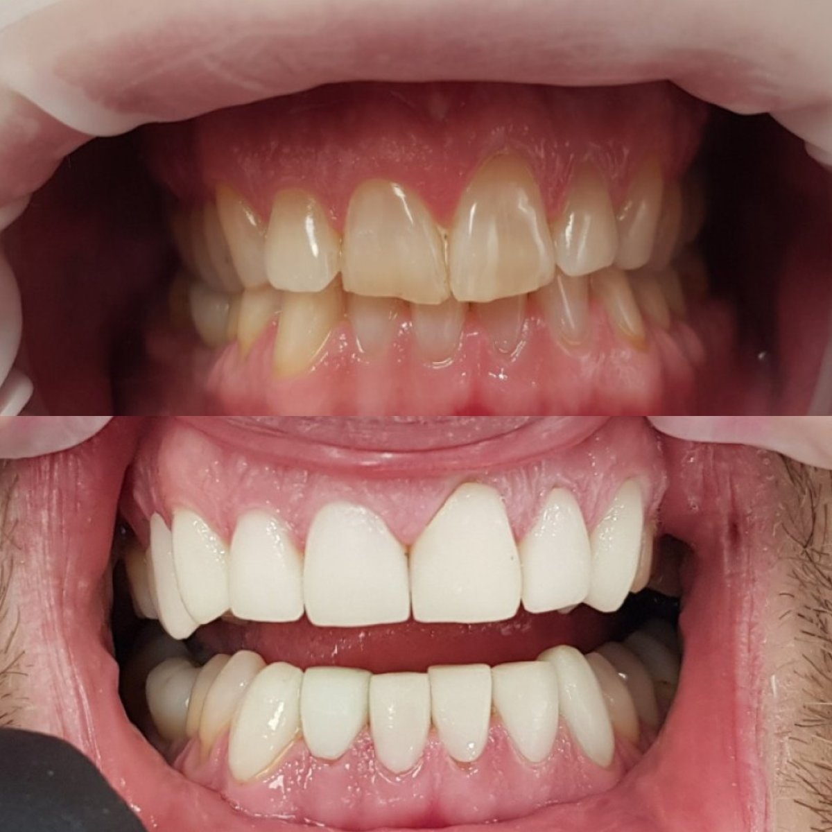 نتائج قبل وبعد قشور البورسلين في عيادة Completdent – تحول الابتسامة