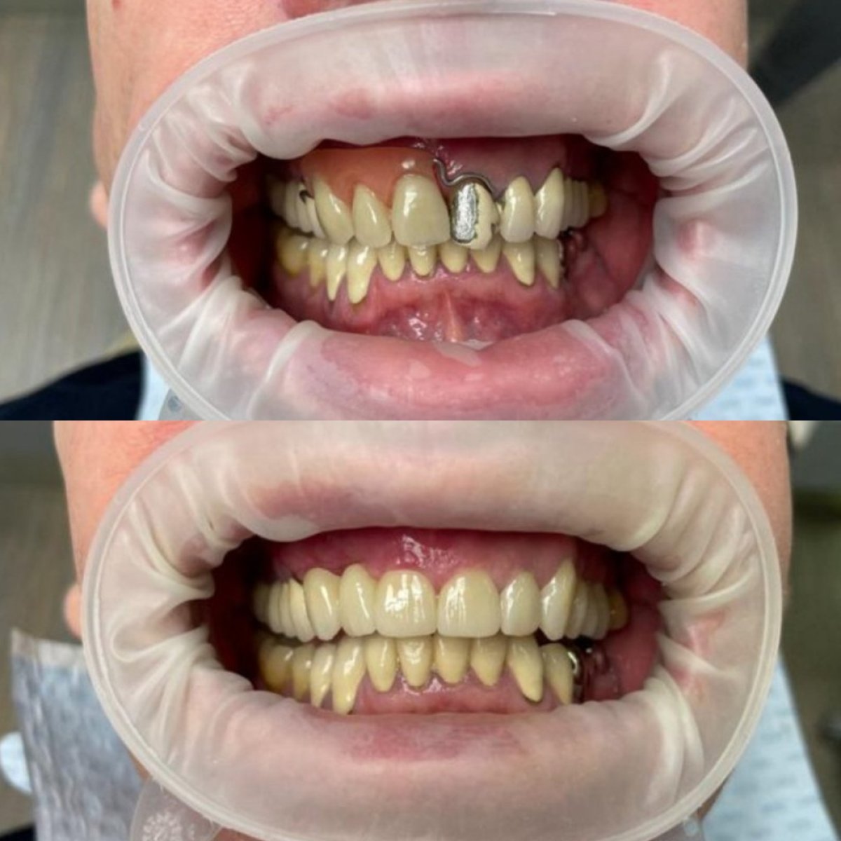 نتائج قبل وبعد جسر الزرع في عيادة Completdent – ابتسامة وأسنان محسنة