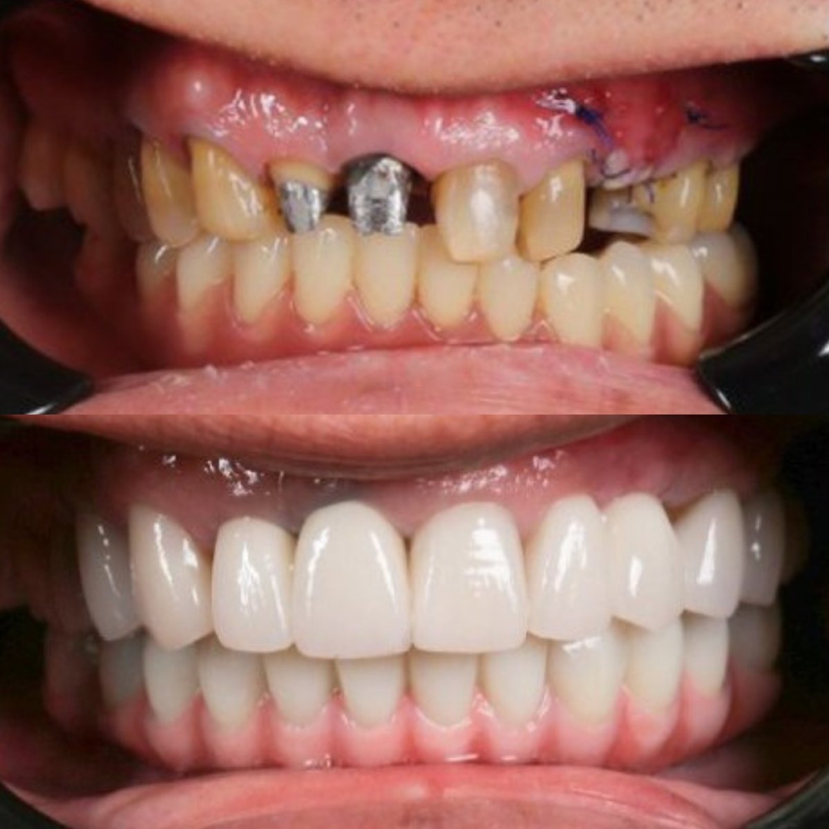 نتائج قبل وبعد تركيب تيجان الأسنان في Dr. Care Implant Clinic، ابتسامة محسنة