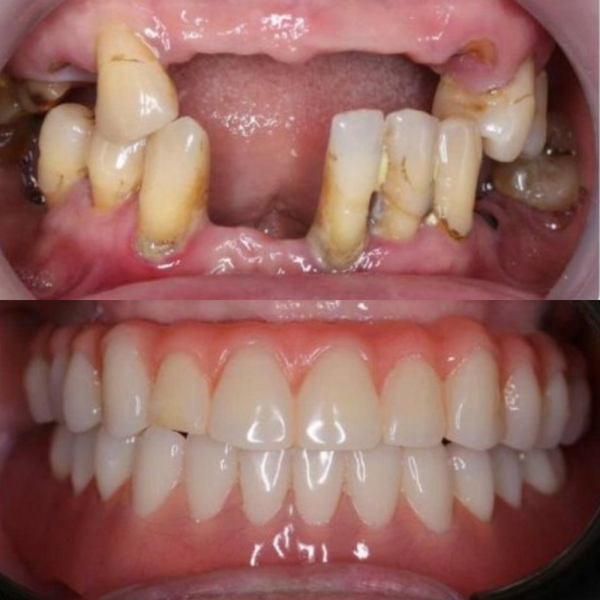 نتائج قبل وبعد زراعة الأسنان مع التاج في Dr. Care Implant Clinic، استعادة الابتسامة