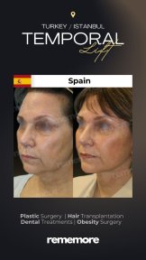before-after photo upper-eyelid-surgery