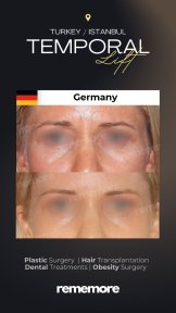 before-after photo upper-eyelid-surgery