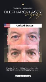 before-after photo upper-eyelid-surgery
