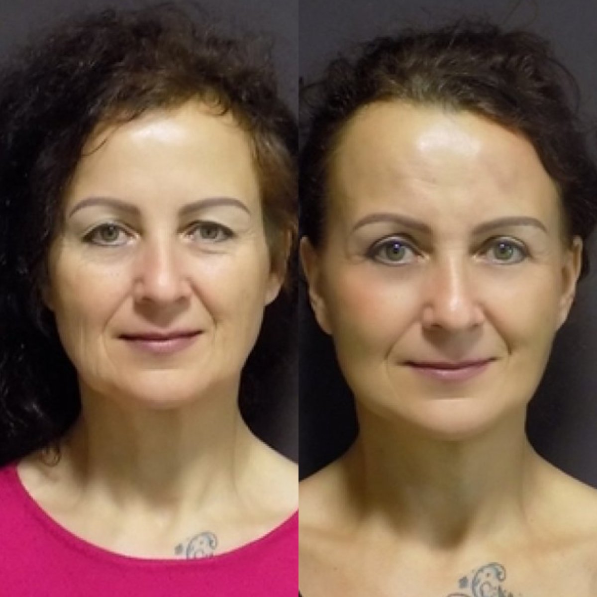 نتائج شد الوجه قبل وبعد في FORME Clinic – تجديد شباب الوجه وبشرة أكثر نعومة