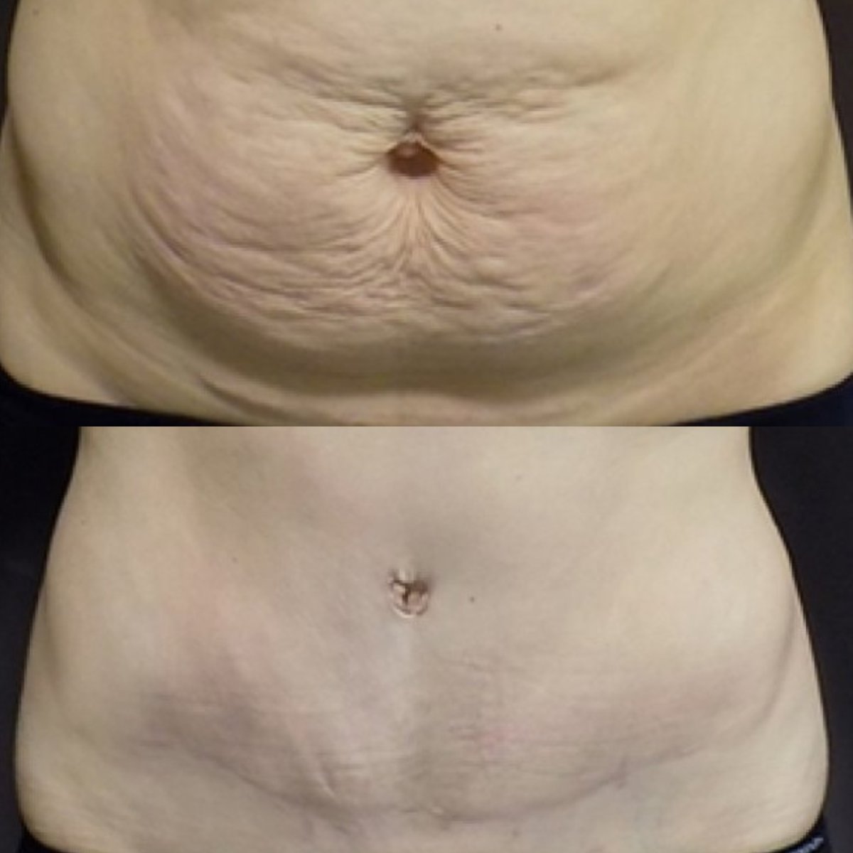 Resultados de abdominoplastia antes y después en FORME Clinic – mejor contorno abdominal