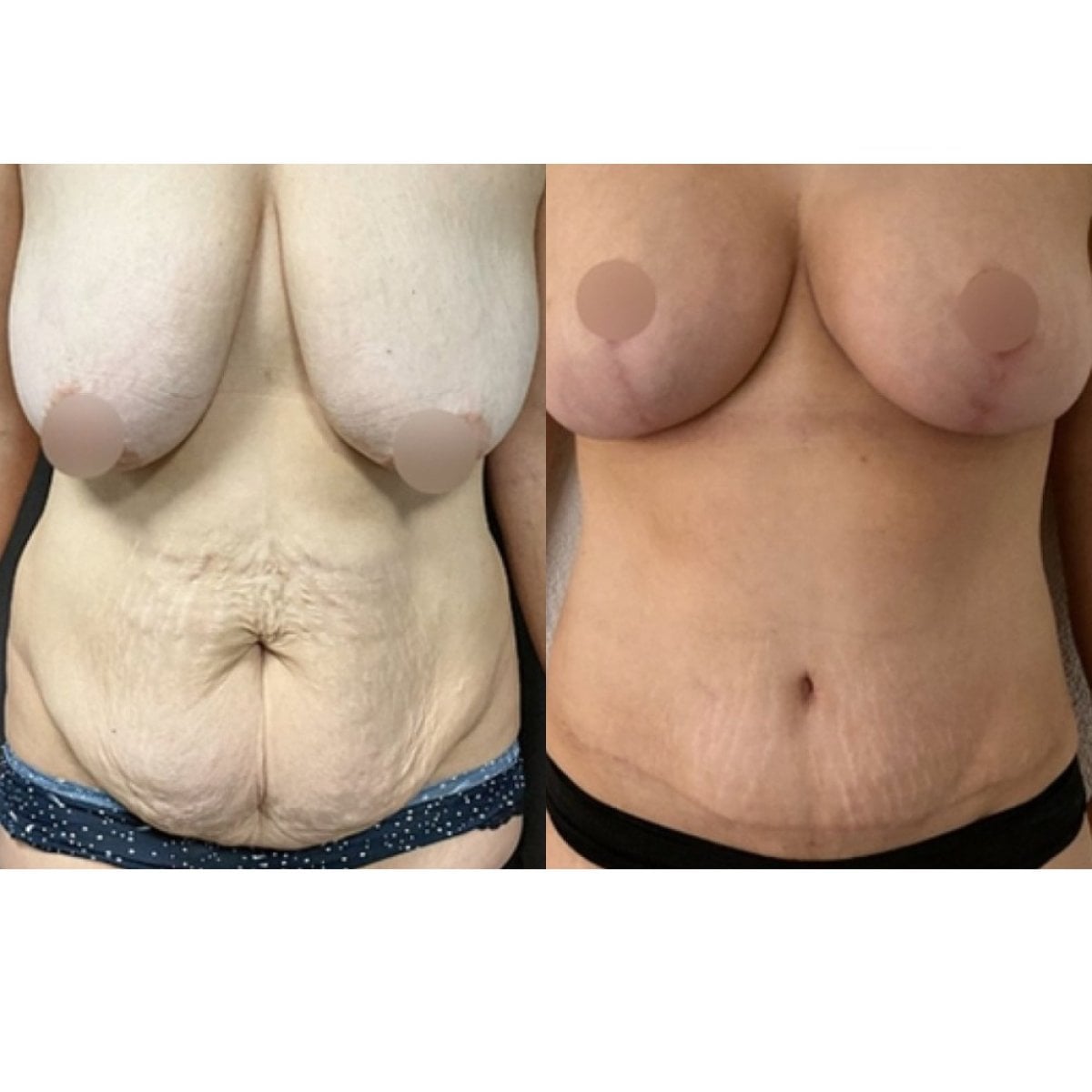 نتائج قبل وبعد عملية تجميل الأم في FORME Clinic – نحت الثدي والبطن