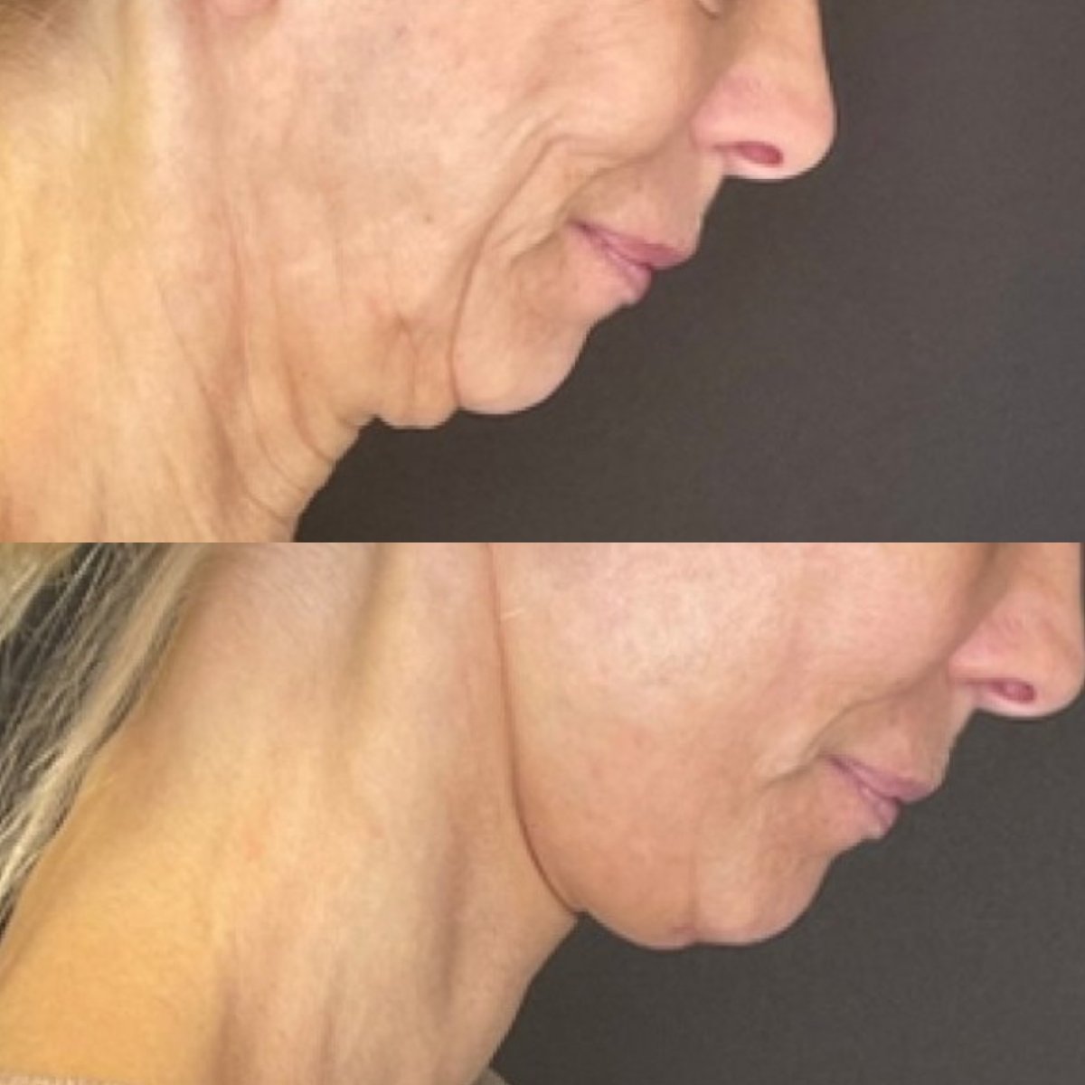 Resultados de lifting de cuello antes y después en FORME Clinic – mejor contorno y piel firme