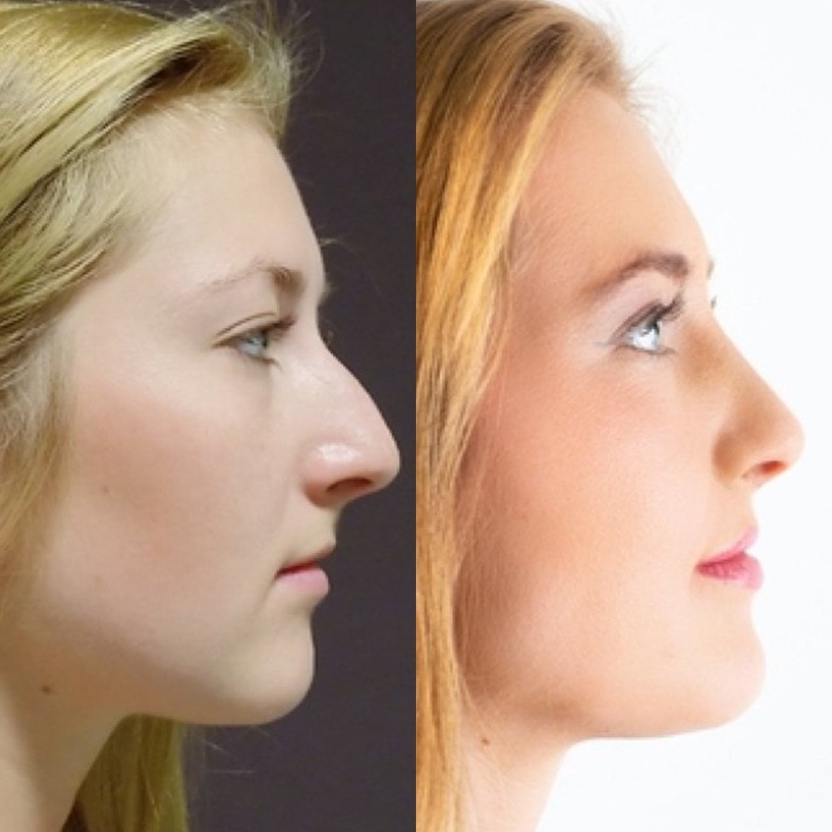 نتائج تجميل الأنف قبل وبعد في FORME Clinic، إعادة تشكيل الأنف بمظهر طبيعي