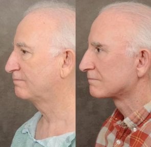 before-after photo tightening-of-facial-skin-facelift