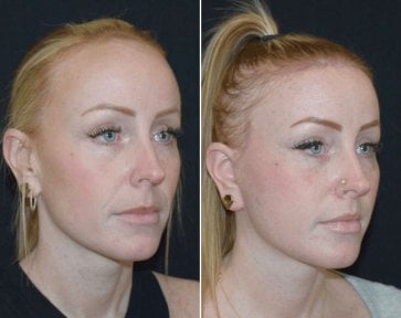 before-after photo tightening-of-facial-skin-facelift