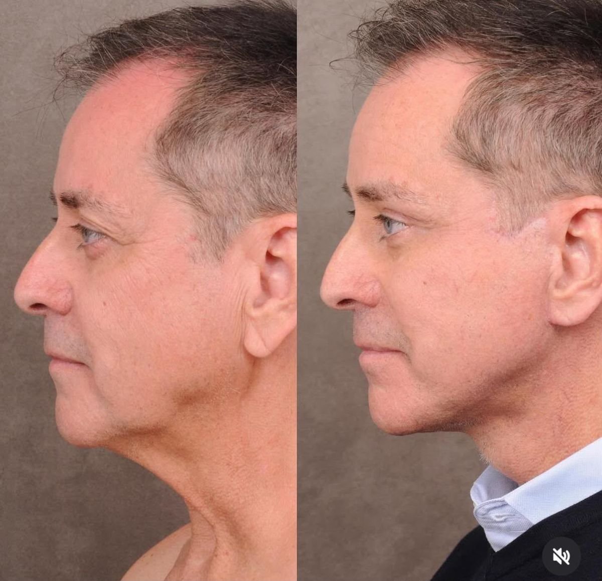 Facelift before and after results at Dr. Alexandro Aguilera - Plastic Surgery, visible jawline lift