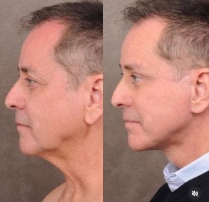 before-after photo tightening-of-facial-skin-facelift
