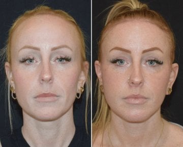 before-after photo tightening-of-facial-skin-facelift