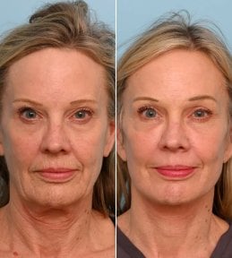 before-after photo tightening-of-facial-skin-facelift