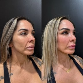before-after photo tightening-of-facial-skin-facelift