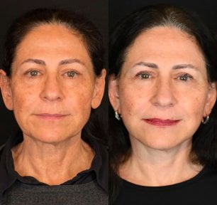 before-after photo tightening-of-facial-skin-facelift