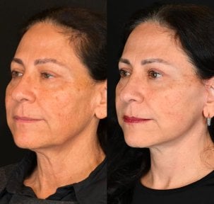 before-after photo tightening-of-facial-skin-facelift