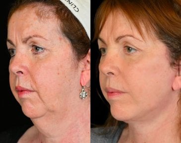 before-after photo tightening-of-facial-skin-facelift
