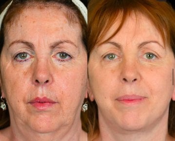 before-after photo tightening-of-facial-skin-facelift